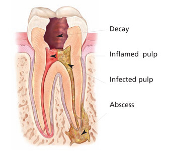 Endodontie - Periapikaler Abszess