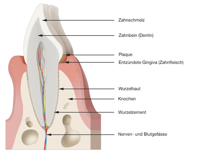 Parodontologie - Entzündetes Zahnfleisch