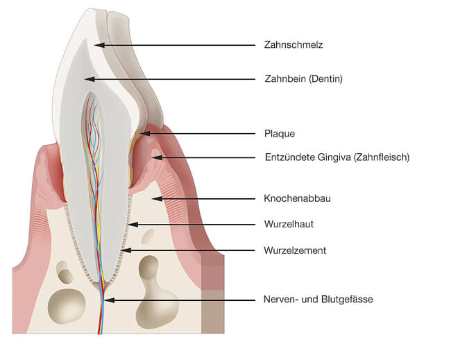 Entzündeter Zahnhalteapparat (Parodontitis)